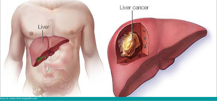What is liver cancer
