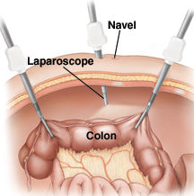 Laparoscopic colon resection surgery