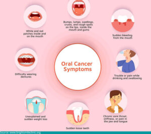 You would know if you had oral cancer