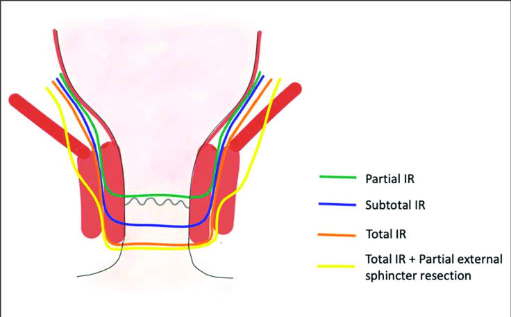 Types of Intersphincteric Resection