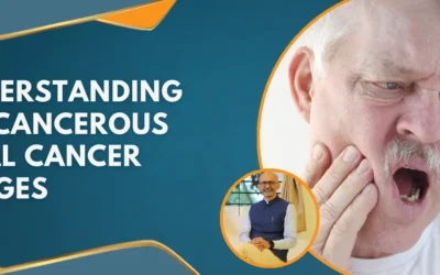 Understanding Precancerous Oral Cancer Stages