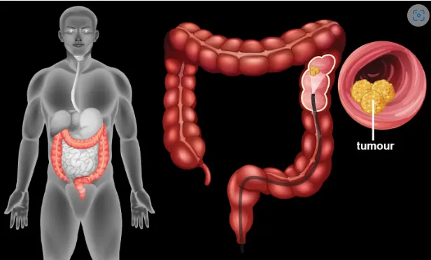 colon cancer tumour