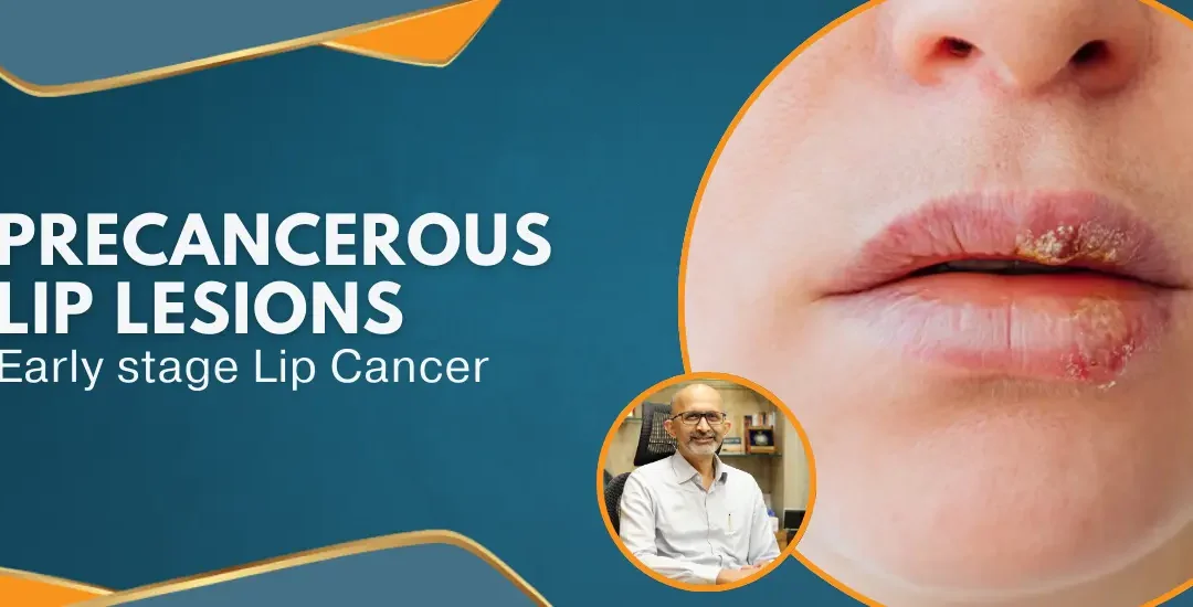 Precancerous lip lesion Early stage Lip Cancer