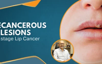 Precancerous lip lesions – Early stage Lip Cancer