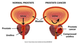 prostate