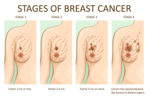 breast cancer