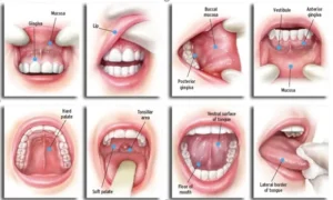 Oral cancer diagnosed