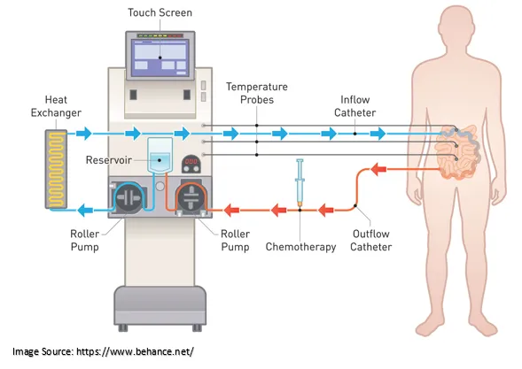 hipec treatment