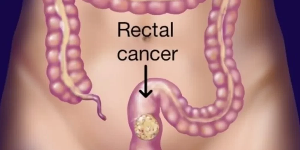 Is ISR Surgery Beneficial for Very Low Rectal Cancer?