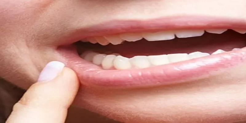 Top 10 Ways To Prevent Oral Cancer