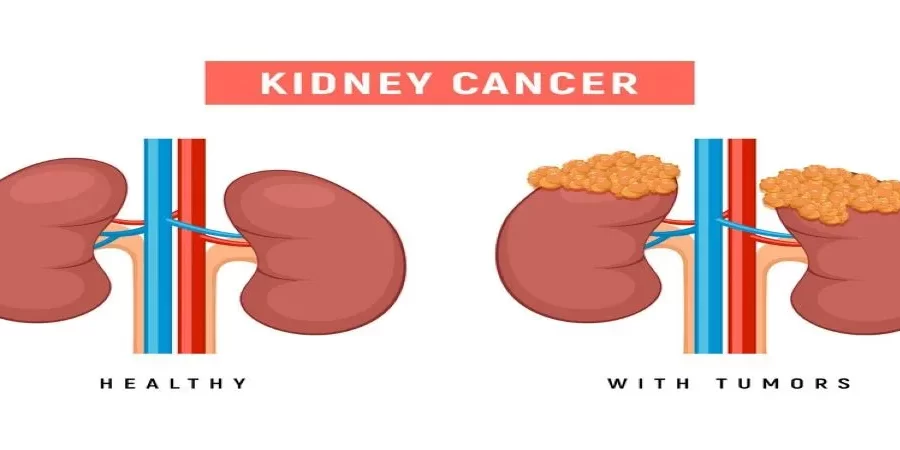 What Early Symptoms Indicate Kidney Cancer
