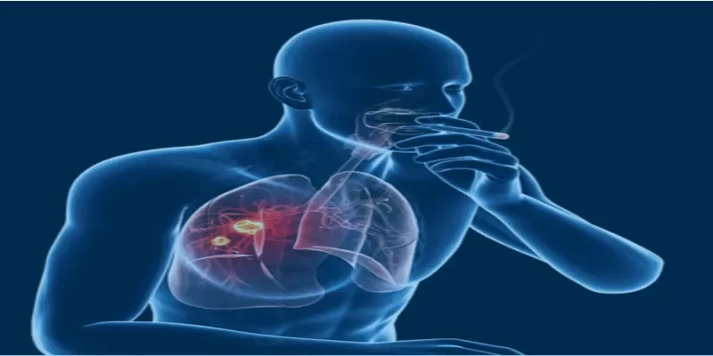 Connection Between Smoking and Lung Cancer