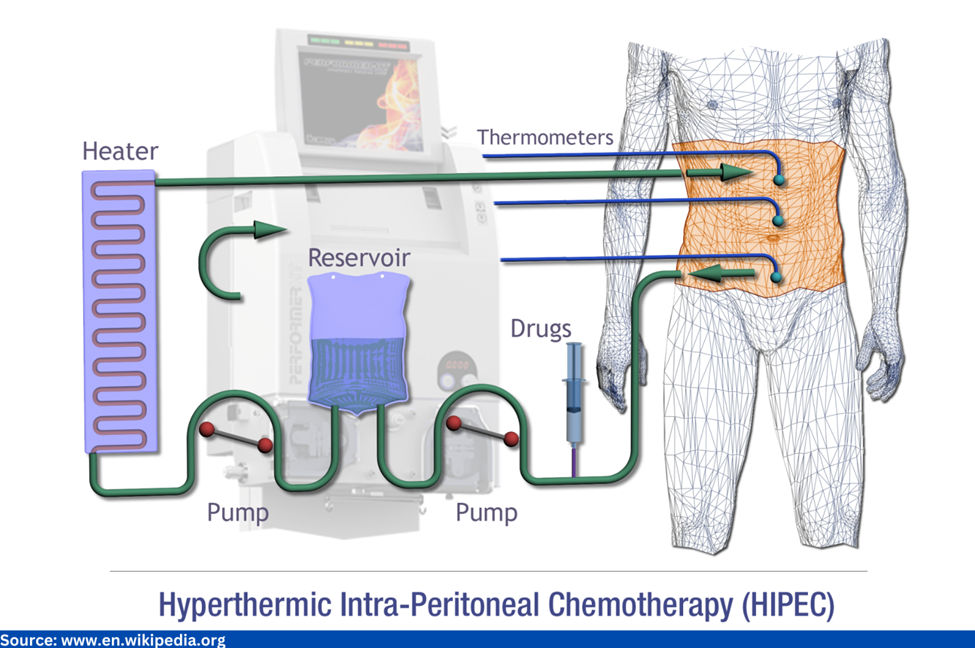 Procedure of Cytoreductive surgery with HIPEC