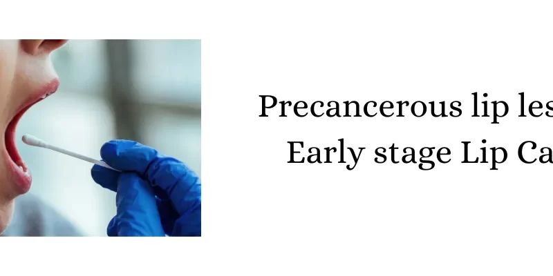 Precancerous lip lesions – Early stage Lip Cancer