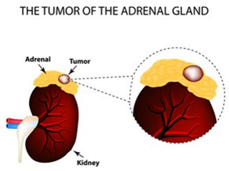 Benign Adrenal Tumors