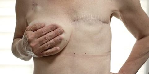 Breast Reconstruction After Breast Cancer