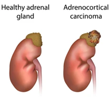 Malignant Adrenal Tumors