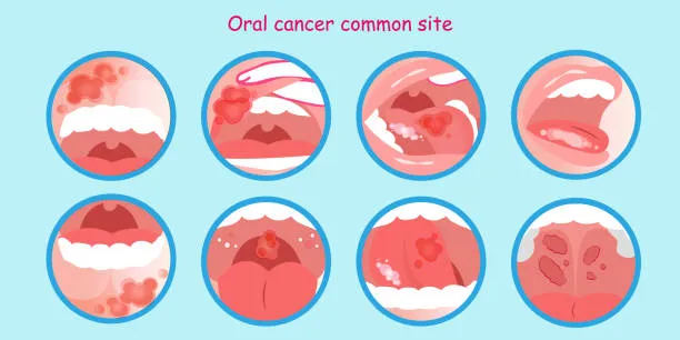 Understanding Precancerous Oral Cancer Stages