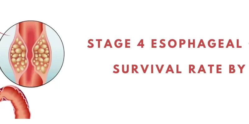 Stage 4 esophageal cancer survival rate by age