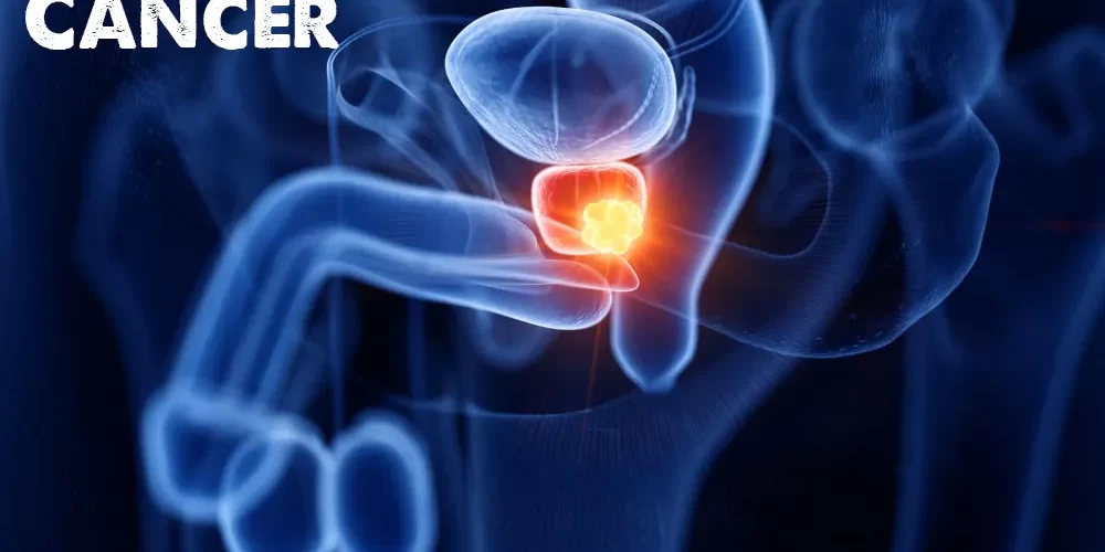 What every man needs to know about Prostate Cancer