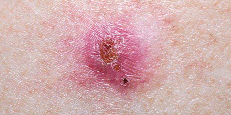 Basal Cell Carcinoma on Breast