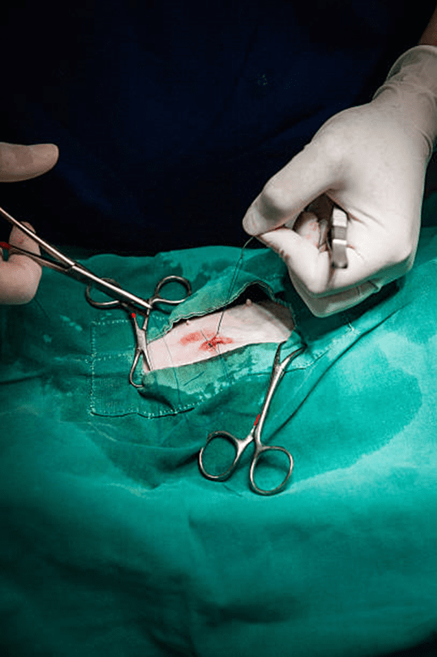 Surgical Excision: