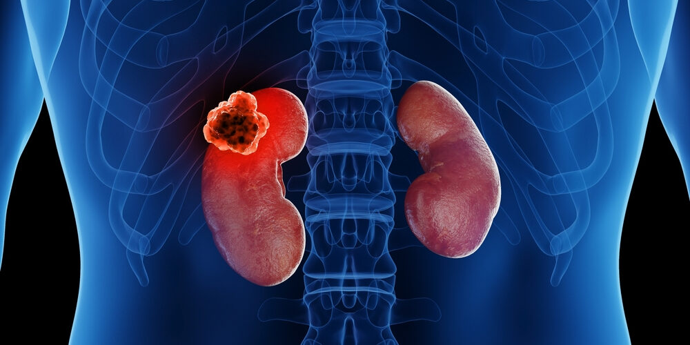 Understanding Metastatic Renal Cell Carcinoma: Symptoms & Treatments