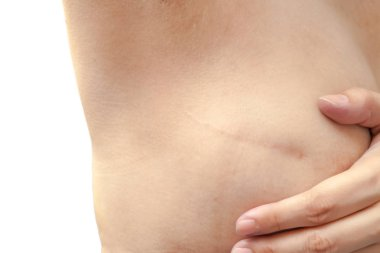 Stages Of Breast Reconstruction After Mastectomy