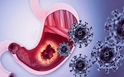 HIPEC for Gastric Cancer Treatment