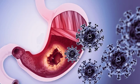 HIPEC for Gastric Cancer Treatment