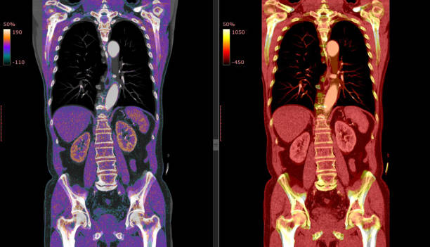 The Role of PET CT in Cancer Diagnosis