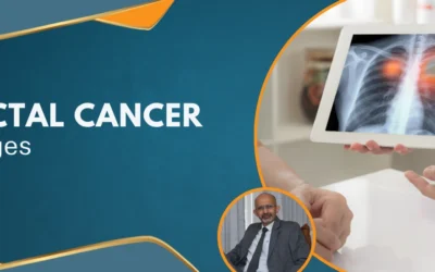 Rectal Cancer Stages
