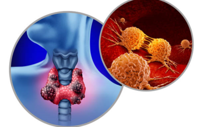 Radioactive Iodine (RAI) Therapy: An Effective Treatment for Thyroid Cancer