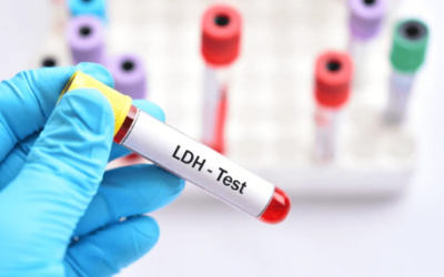 Does High LDH Mean Cancer? Causes & Diagnosis