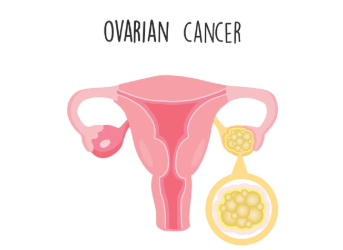 What Are the Symptoms of Ovarian Cancer?