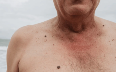 What Is Carcinoma Cancer