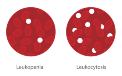 Is Leukocytosis a Cancer