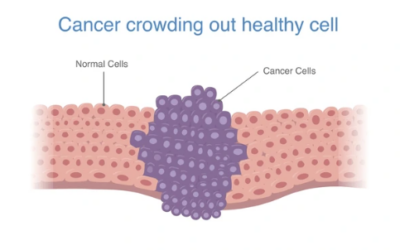 3 Ways Cancer Can Spread