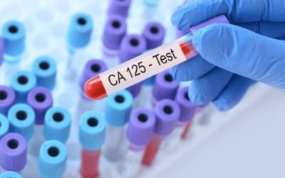 What Level of CA125 Indicates Cancer