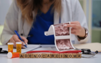 What Stage Is Adenocarcinoma Cancer?