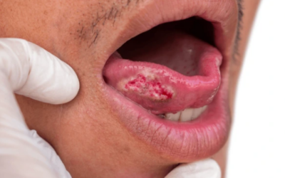 How to Prevent Oral Cancer