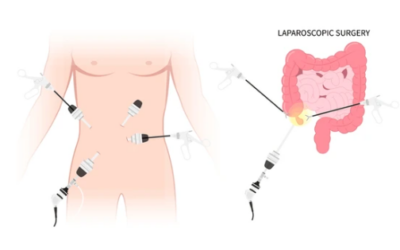 Benefits of Laparoscopic Cancer Surgery