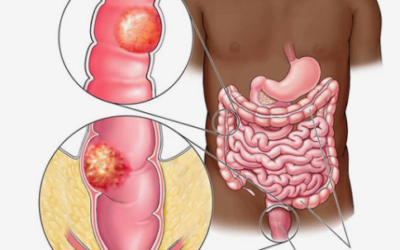 Best Colon Cancer Surgeon in Bangalore