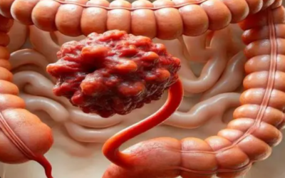 Best Rectal Cancer Surgeon in Bangalore Without Permanent Stoma?