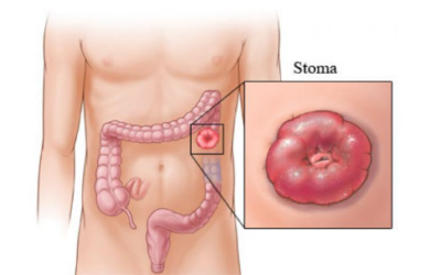 Can Rectal Cancer Be Treated Without a Colostomy Bag?
