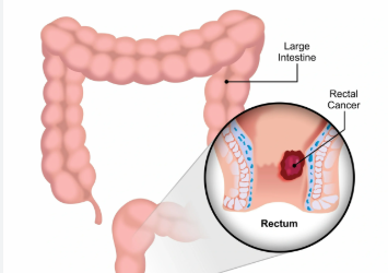 How Soon Can I Get a Cancer Surgery Appointment in Bangalore?
