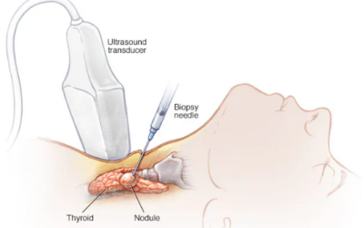 Is Thyroid Cancer Curable With Surgery?
