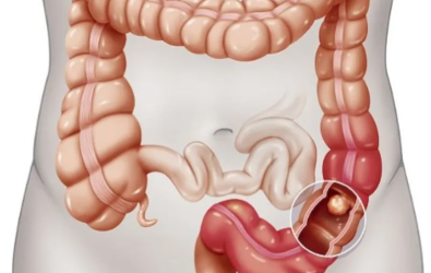 Rectal Cancer vs Colon Cancer