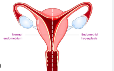 What Endometrial Thickness Indicates Cancer?