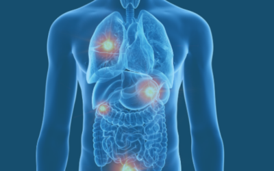 What Is Metastatic Cancer?